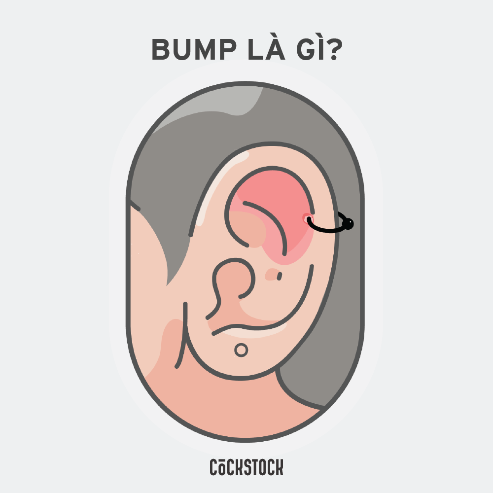Bump lỗ tai hay còn gọi là mụn nước là một trong số những vấn đề thường gặp với lỗ xỏ