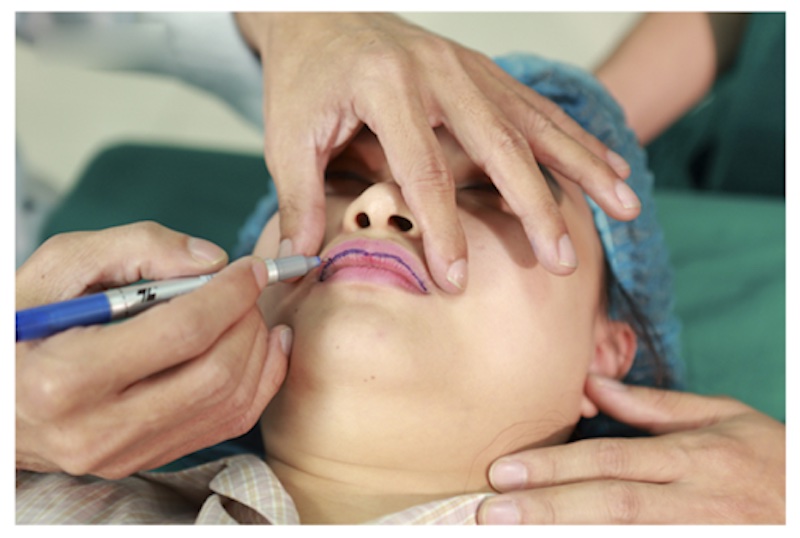 Phẫu thuật thẩm mỹ giúp môi nhỏ gọn và cân đối