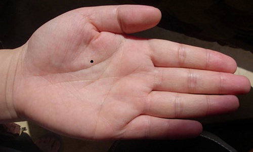 nốt ruồi ở lòng bàn tay